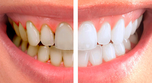 professionalnaya-chistka-zubov
