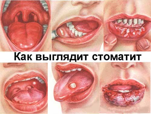 Стоматит | Сервис Дент - стоматология в Алматы